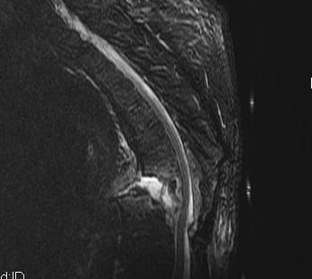 Ankylosing Spondylitis Fracture MRI Spine